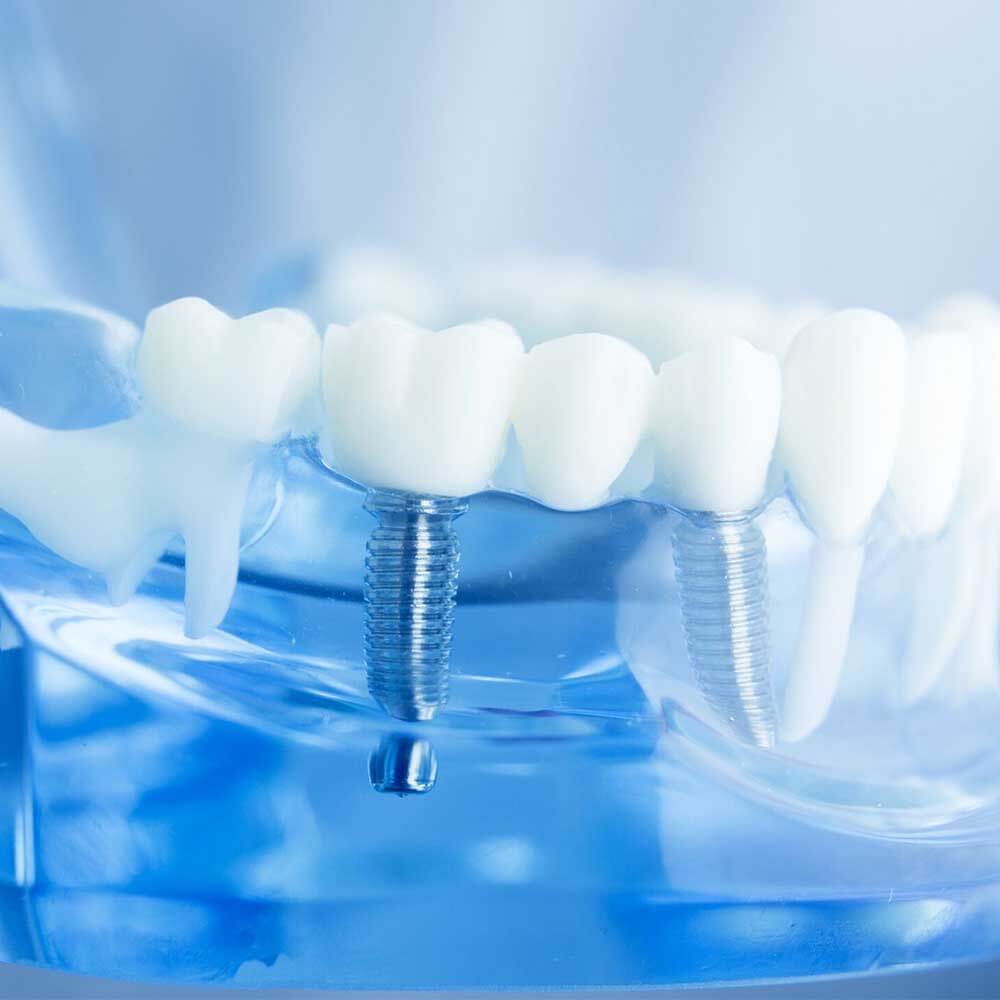 family dentistry kierland dental arts scottsdale az services dental implants