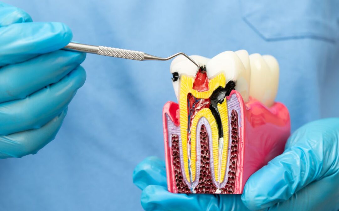 The Role of Root Canal Treatment for Damaged Teeth in Restoring Oral Health