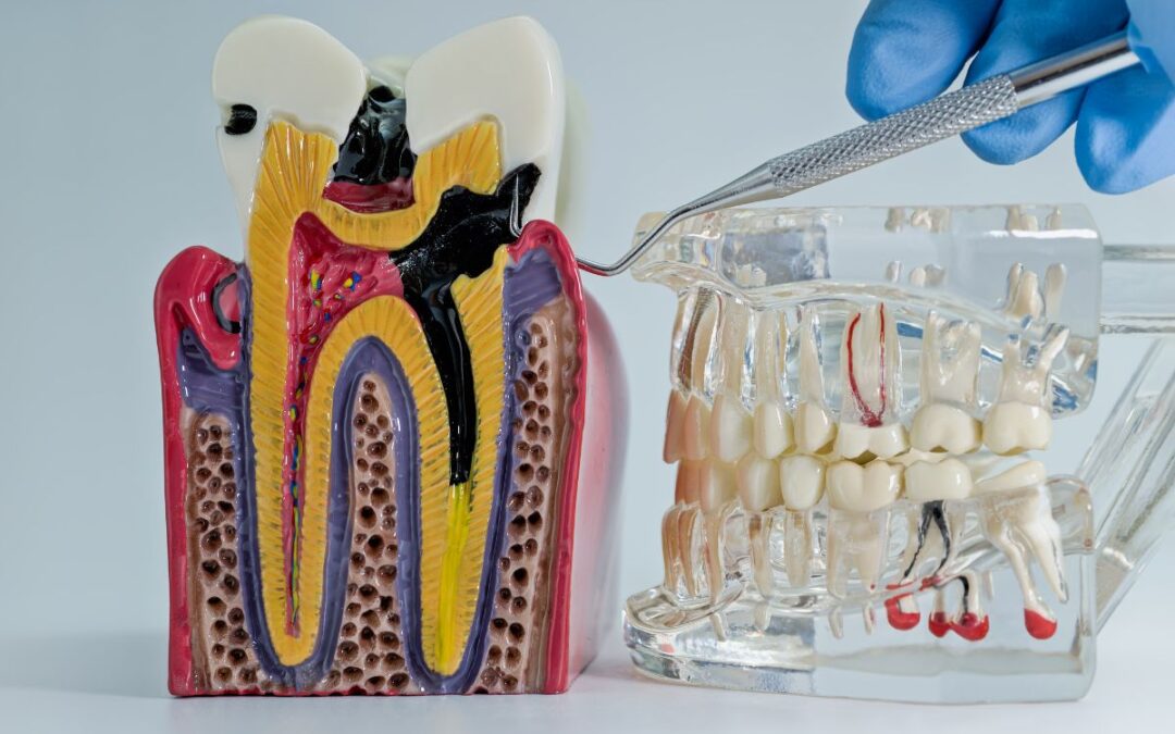 Tooth Pain After a Root Canal: What’s Normal and When to Be Concerned