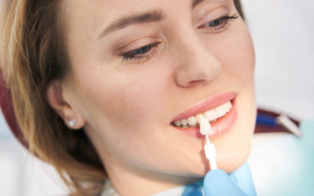 Aftercare for Veneers: What You Need to Know