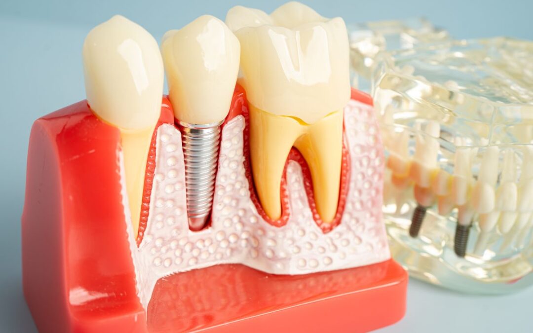 Implant Options for Two Missing Teeth Next to Each Other
