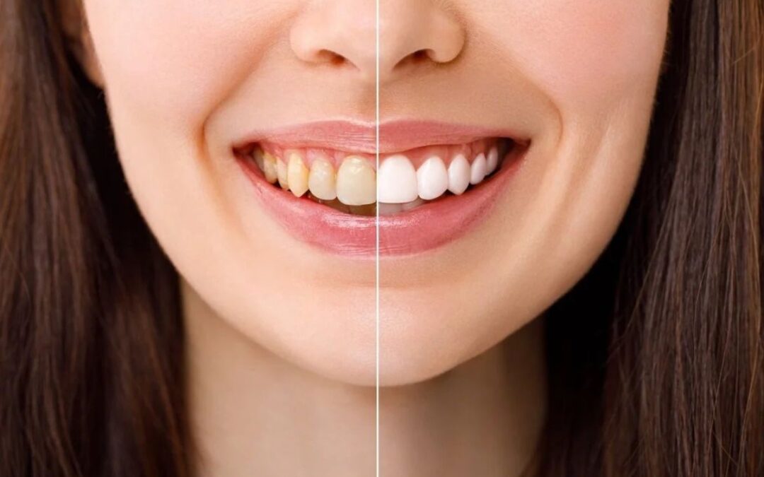 Teeth Whitening Treatment That Is Safe for Enamel