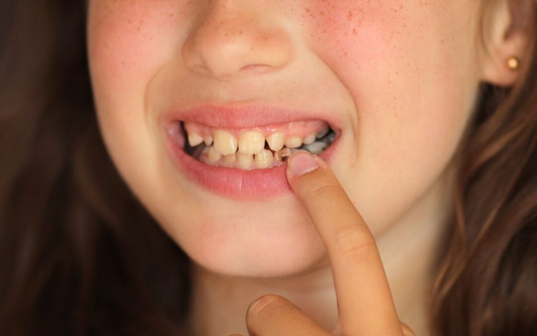 Child showing early signs of tooth decay in baby teeth