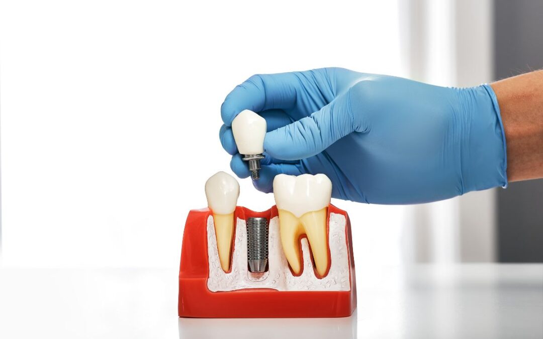 dental implant model close-up