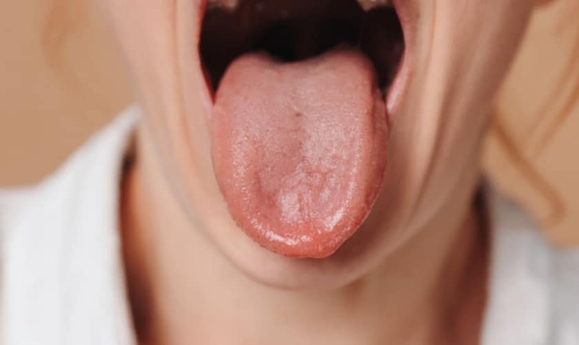 Get Rid of White Tongue